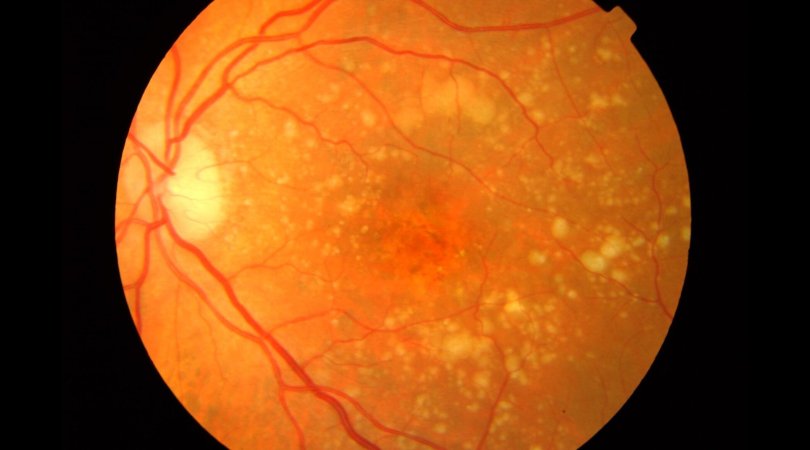 Degeneración Macular Relacionada Con La Edad