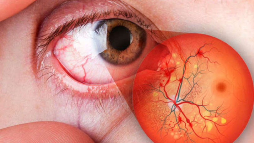 Retinopatía Diabética